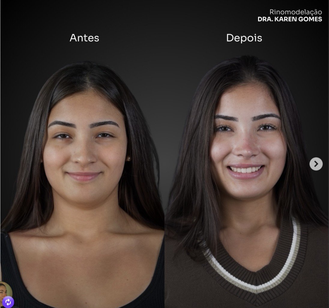 Antes e depois — rinomodelação definitiva, vista frontal