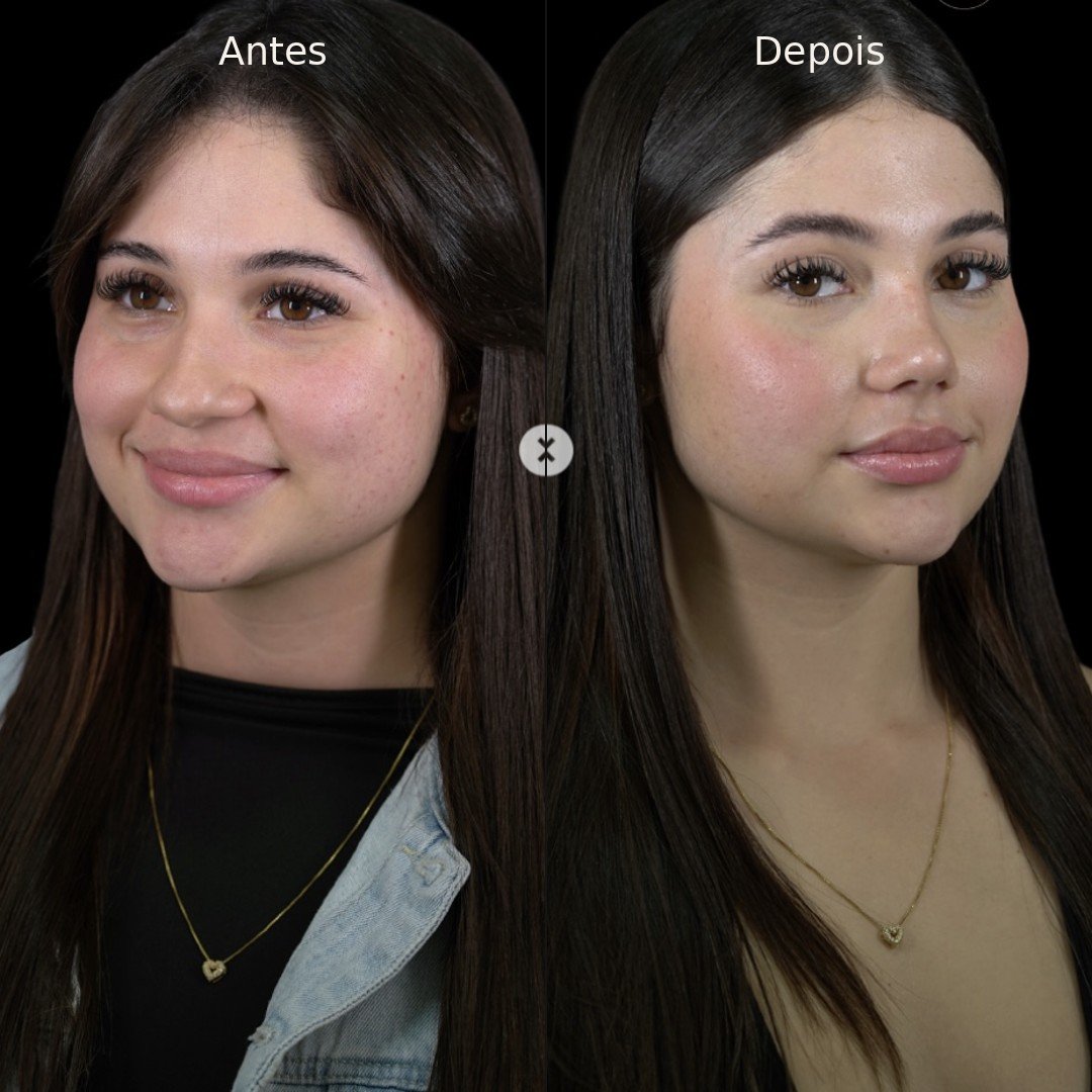Antes e depois — rinomodelação definitiva, vista em três quartos