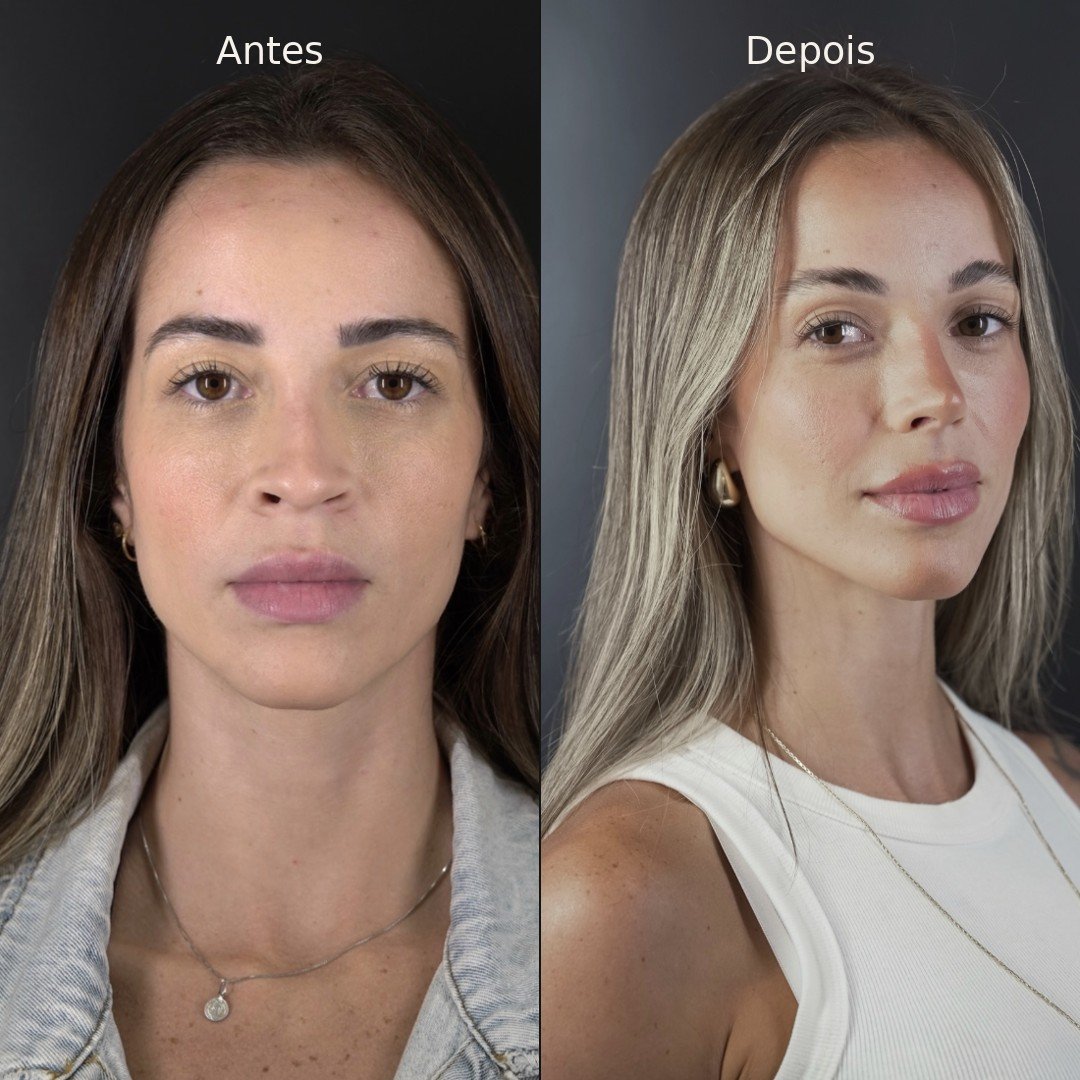 Antes e depois — rinomodelação definitiva, vista frontal